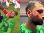 Gianluigi Donnarumma lider av ansiktstrauma efter hårresande spark under matchen mellan Monaco och PSG
